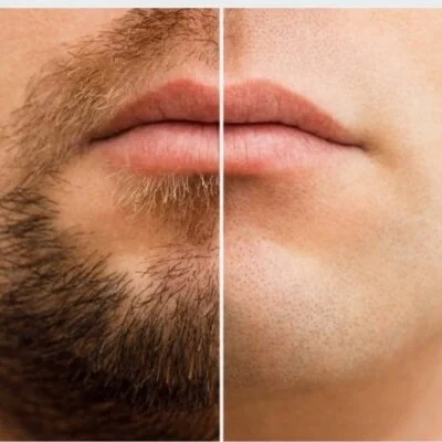 ヒゲ脱毛、VIO脱毛