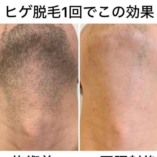 自分へのご褒美⭐お盆休みは全身脱毛・VIO脱毛は如何ですか？